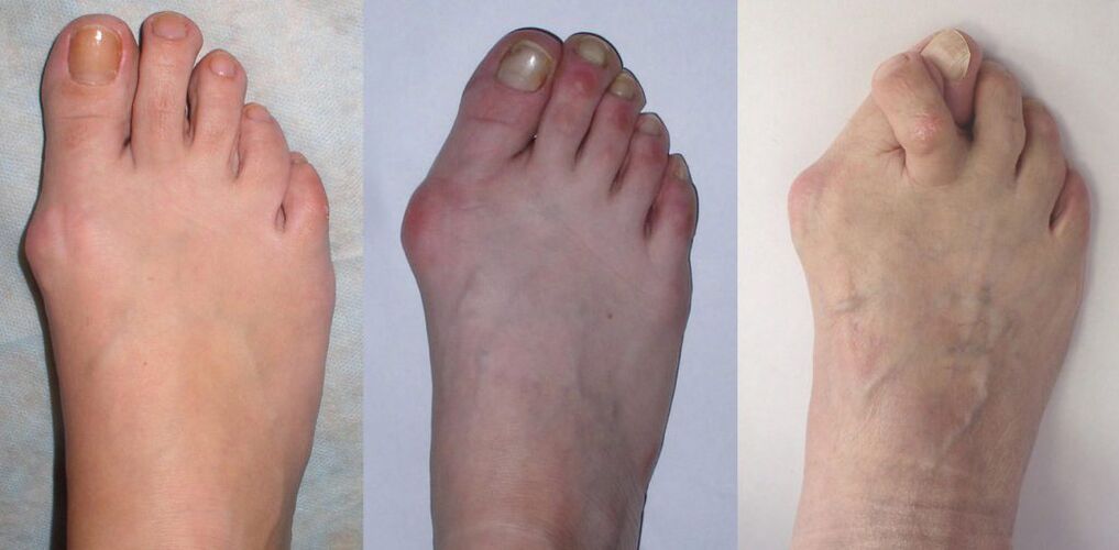 Foot arthritis
