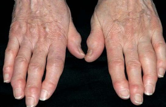 Osteoarthritis of the hands