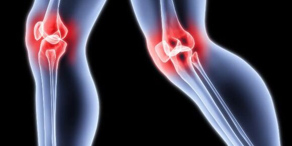 Osteoarthritis of the knee
