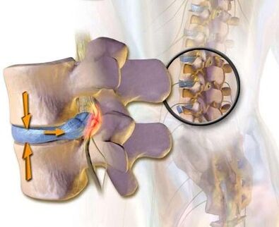 Vascular brown syndrome