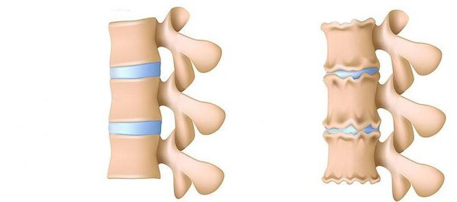 What is osteochondrosis