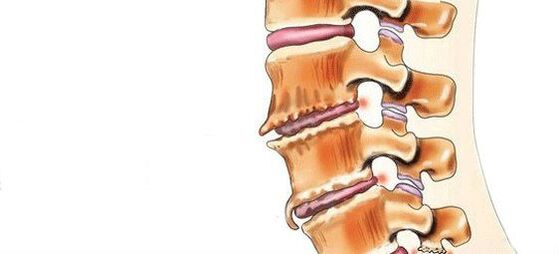 What is spondylosis