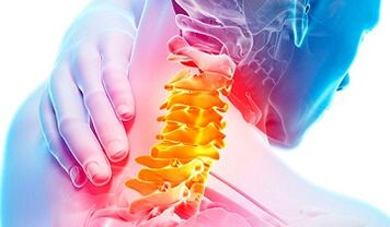 Signs of osteochondosis of the cervical column