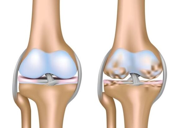 What is gonartrosis