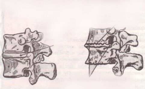 The intervertebral disc is healthy and with lumbar osteochondosis