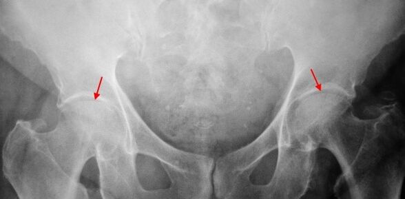 Double facade coksartrosis that support the joint gap, sclerosis of the joint surfaces