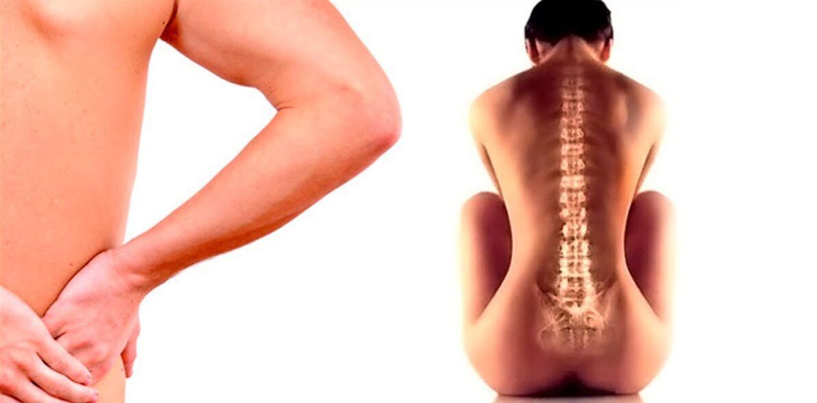 low back pain due to osteochondrosis