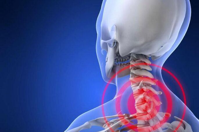 Shooting neck pain is an early symptom of cervical osteochondrosis