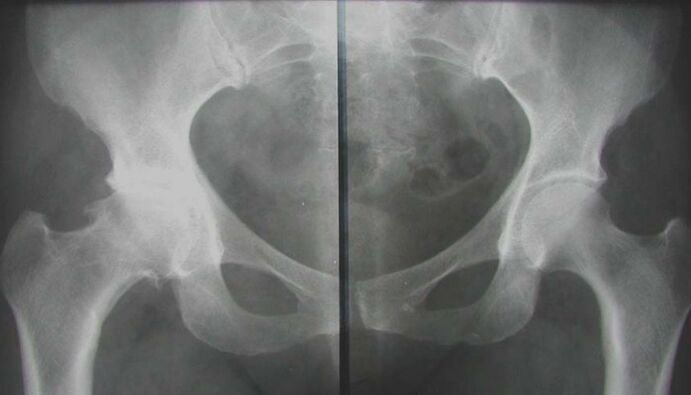 X-ray of the hip joint affected with osteoarthritis
